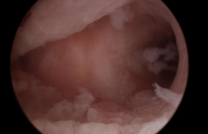 Hysteroscopy – Rockingham Women's Health Centre